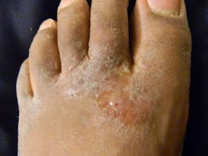 colloidalcare-athletes_foot